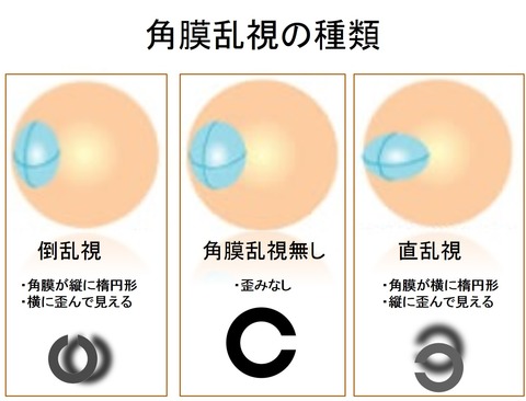 角膜乱視